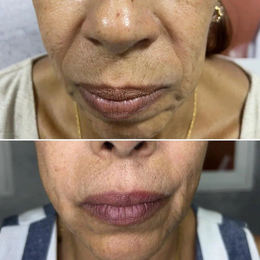 Sulcos e bigode chinês