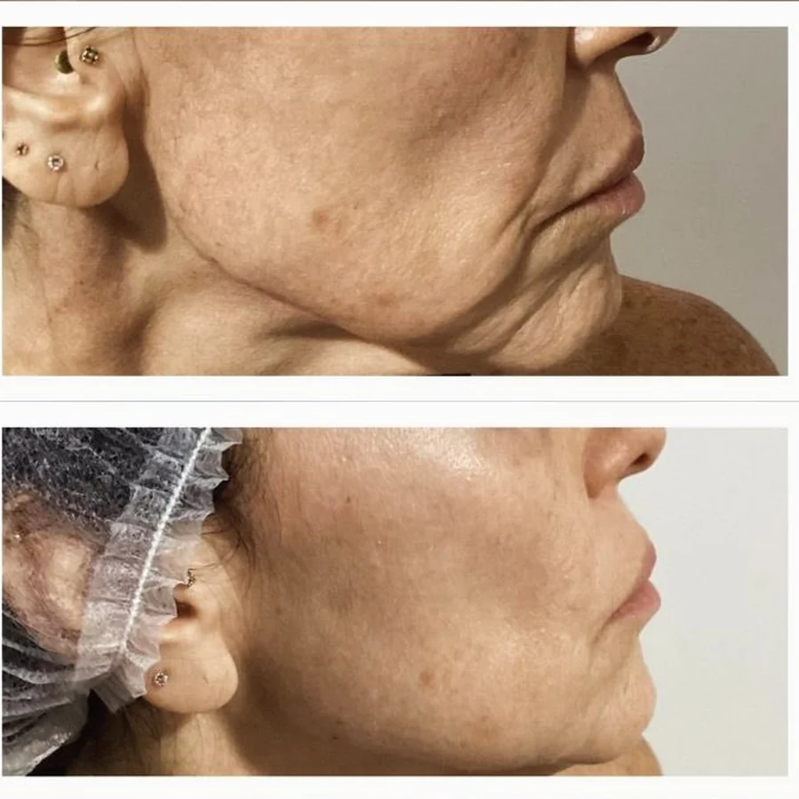 Flacidez facial