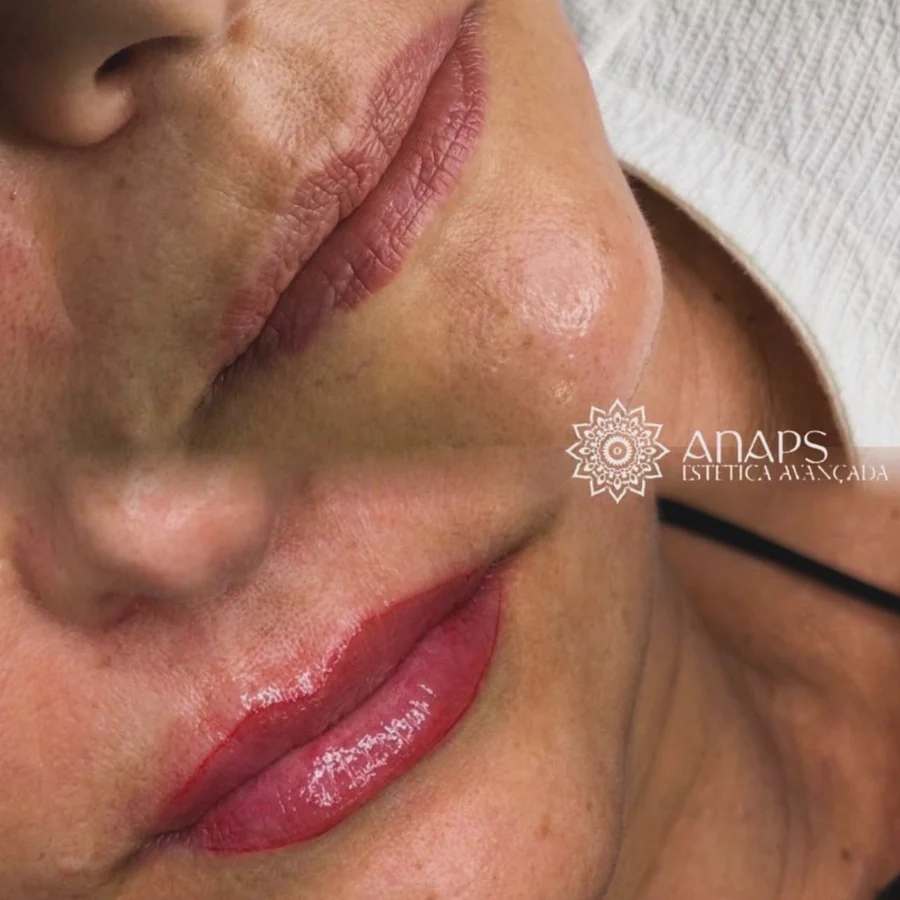 Preenchimento labial
